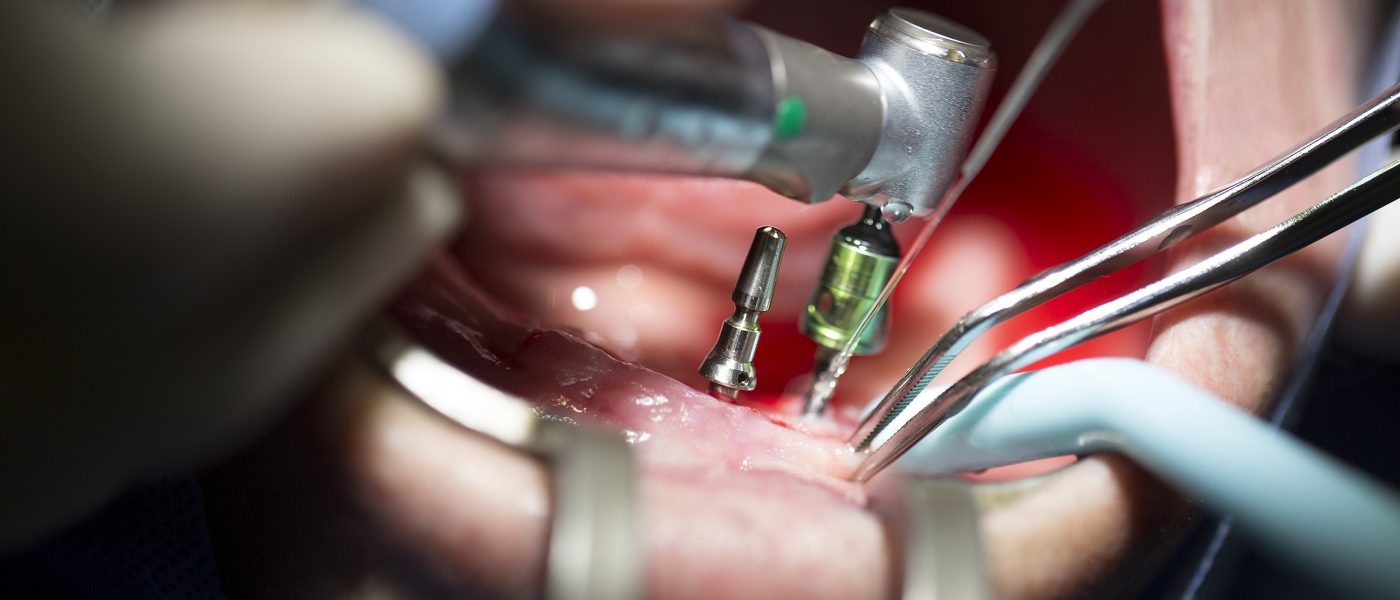 postitulo-especializacion-odontologica-en-implantologia